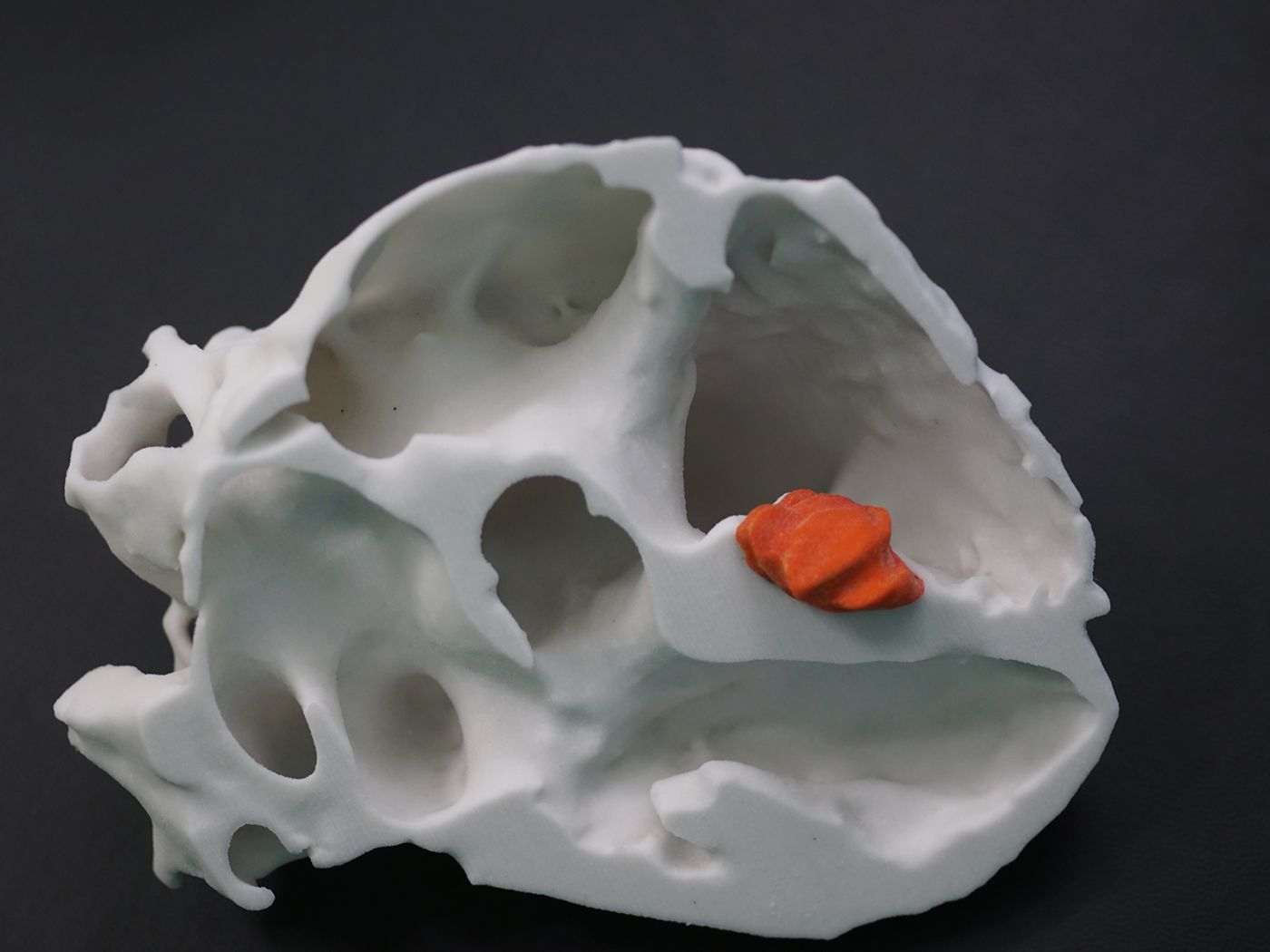 Ein dreidimensionales Modell eines Herzens mitsamt Tumor