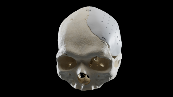 Am Universitätsspital Basel ist im August zum ersten Mal einem Patienten eine künstliche Schädeldecke implantiert worden, die am USB eigens für ihn hergestellt wurde. Nach mehrjähriger Forschung und Entwicklung ist es dem USB als erstem Spital in Europa gelungen, im 3D-Druckverfahren Implantate zu produzieren, die den Ansprüchen der internationalen Medizinprodukte-Standards genügen. 